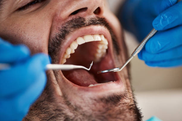 Best Emergency Tooth Extraction in Pottsville, PA